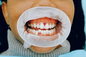 Tooth Infection