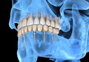dental implant