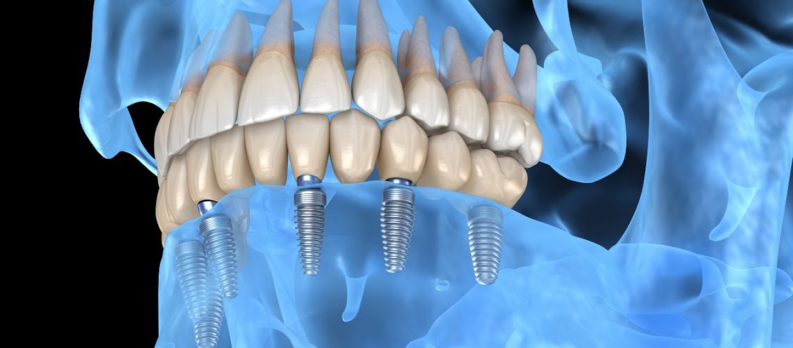 dental implant