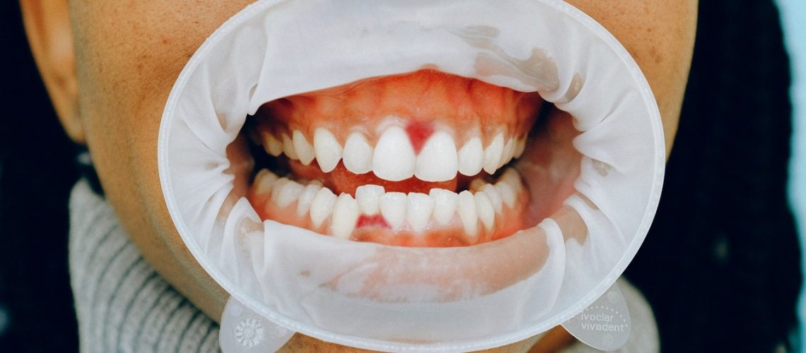 Tooth Infection